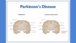 Parkinsonda Cigir Acan Bulus