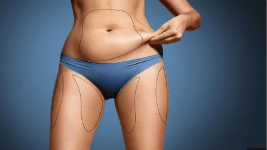 liposuction
