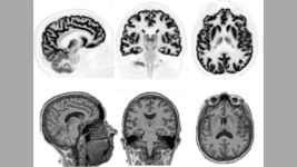 Antimadde ve PET Görüntüleme Devrim